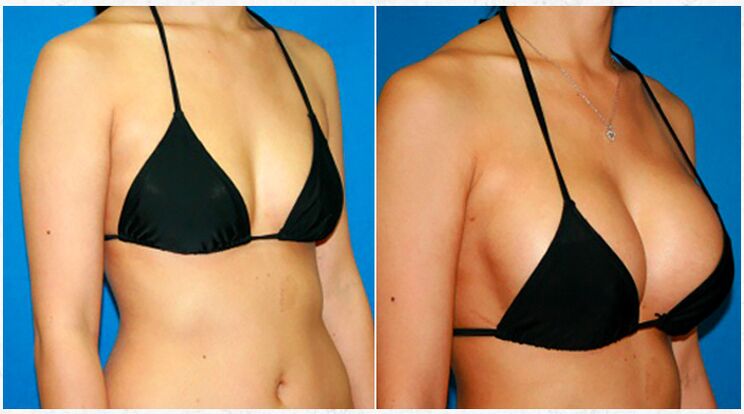 Before and after breast enlargement with plastic surgery