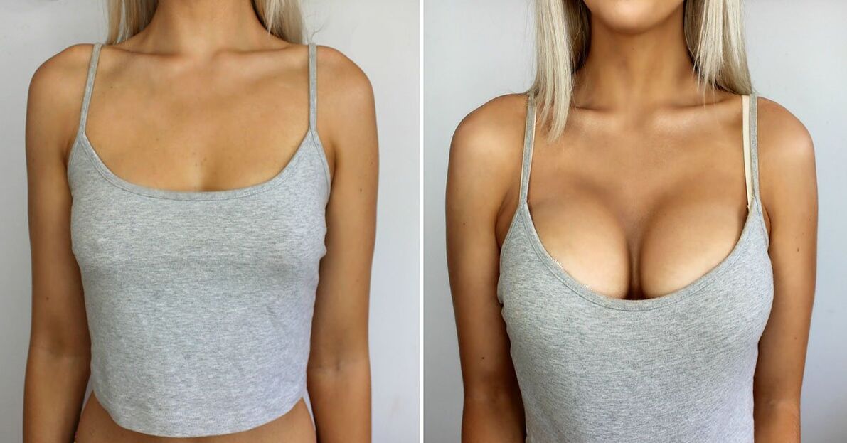 Before and after breast augmentation