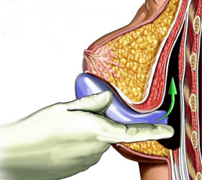Breast enlargement implantation