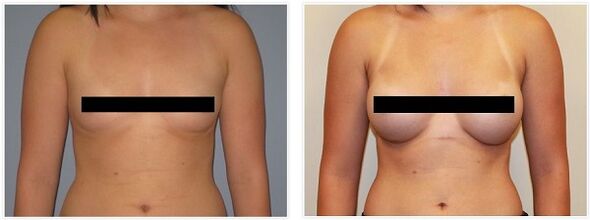 Breasts before and after surgery