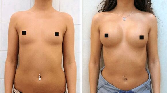 Photos before and after breast augmentation surgery