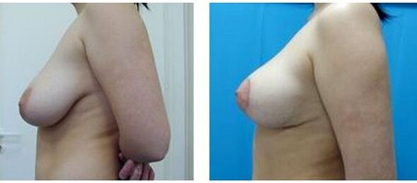 before and after breast augmentation surgery