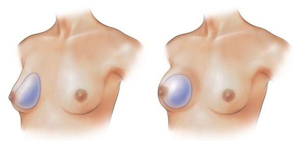 teardrop-shaped and round implants for breast enlargement